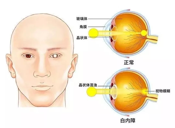 白内障示意图图片